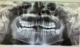 拔智齿视频全真实过程,拔智齿的真实手术过程